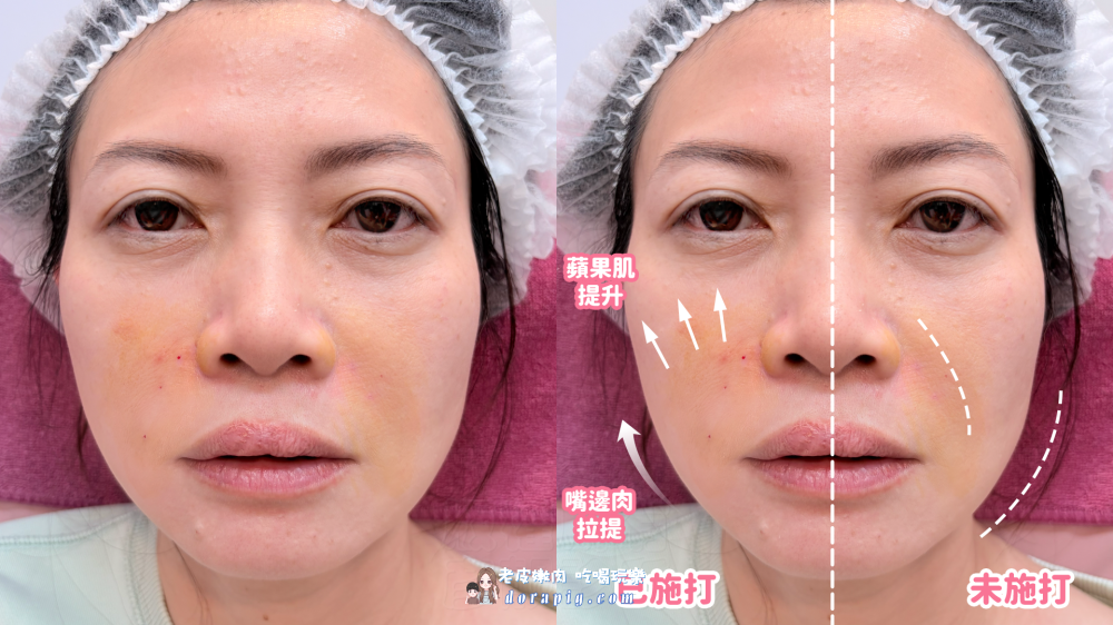 告別老態紋！4D無痕筋膜提升法令紋心得真實體驗(含材質及恢復期) - 老皮嫩肉的流水帳生活
