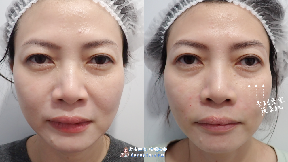 告別老態紋！4D無痕筋膜提升法令紋心得真實體驗(含材質及恢復期) - 老皮嫩肉的流水帳生活