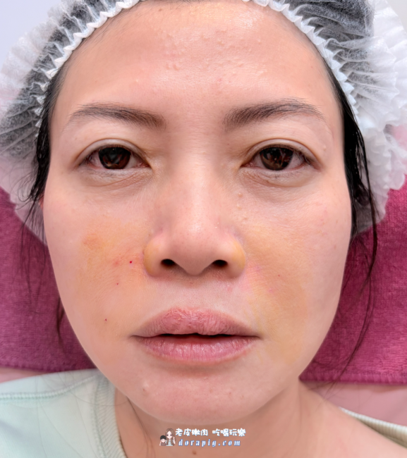 告別老態紋！4D無痕筋膜提升法令紋心得真實體驗(含材質及恢復期) - 老皮嫩肉的流水帳生活